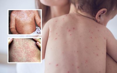 Alerta sobre a situação do SARAMPO na região Norte do Brasil